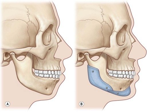 Maxillary Prognathism Treatment