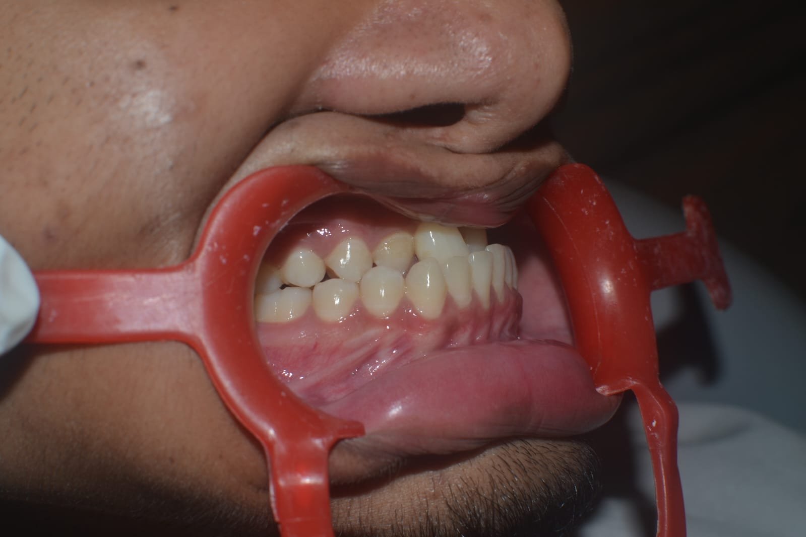 Orthognathic Surgery Procedure