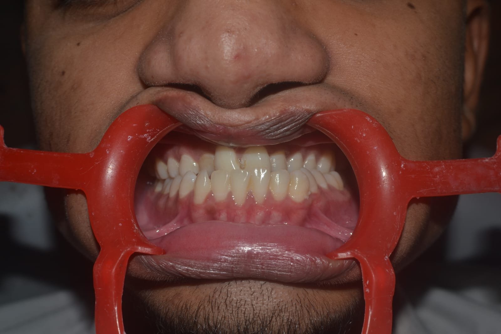 Maxillary Surgery Result