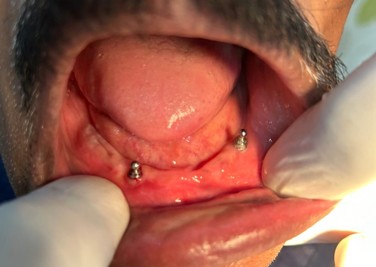 Maxillary Prognathism Treatment