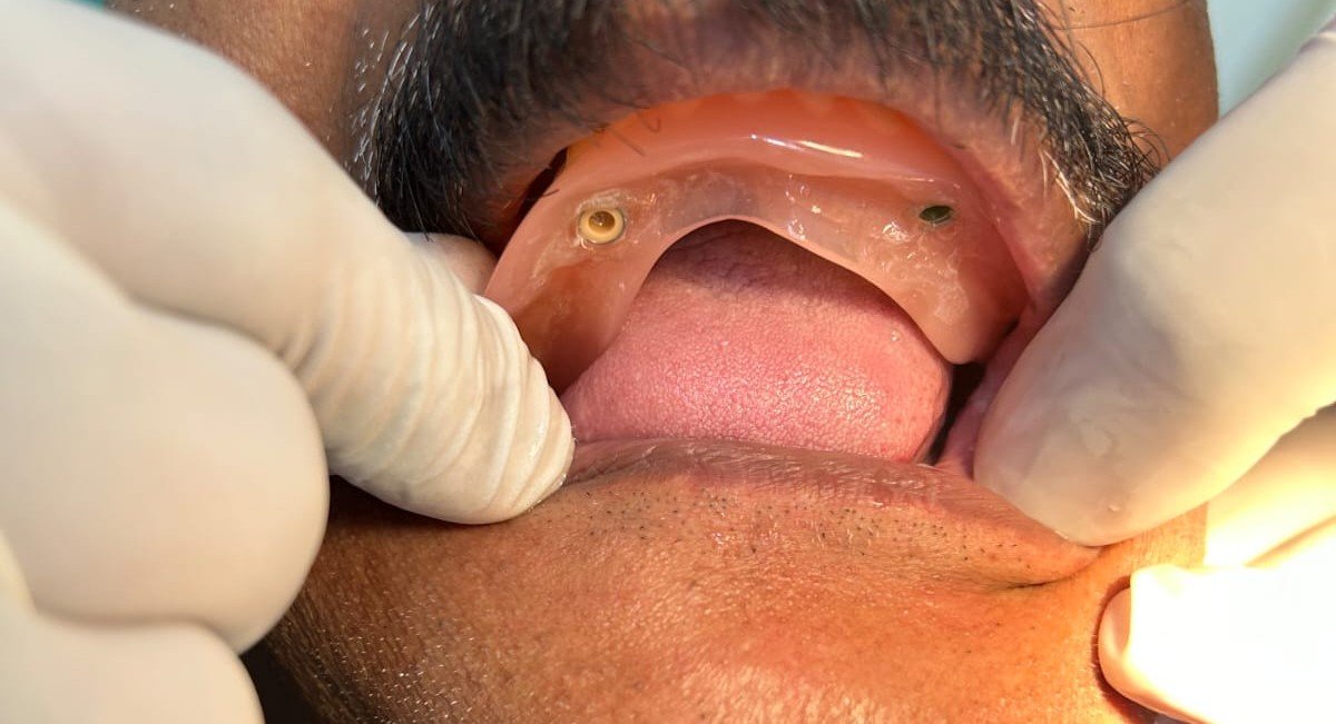 Jaw Correction Surgery