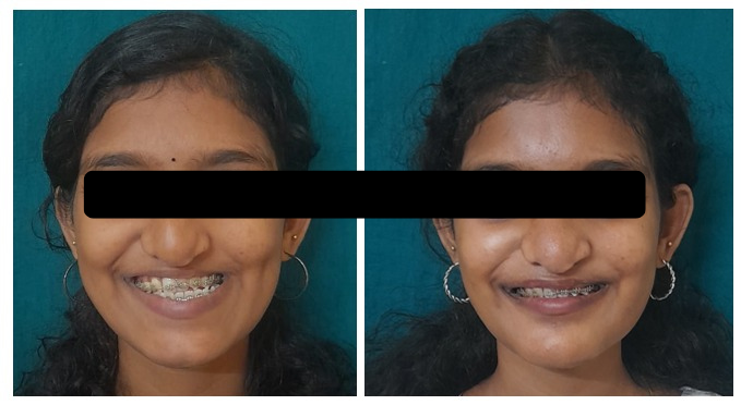 Maxillary Hypoplasia