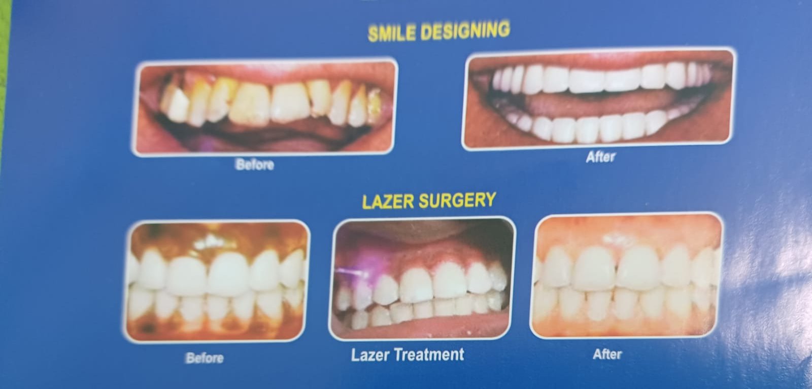Maxillary Prognathism Treatment