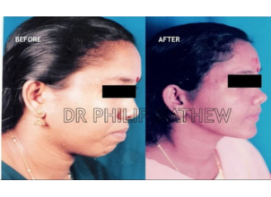 Maxillary Prognathism Treatment