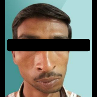 Maxillary Prognathism Treatment