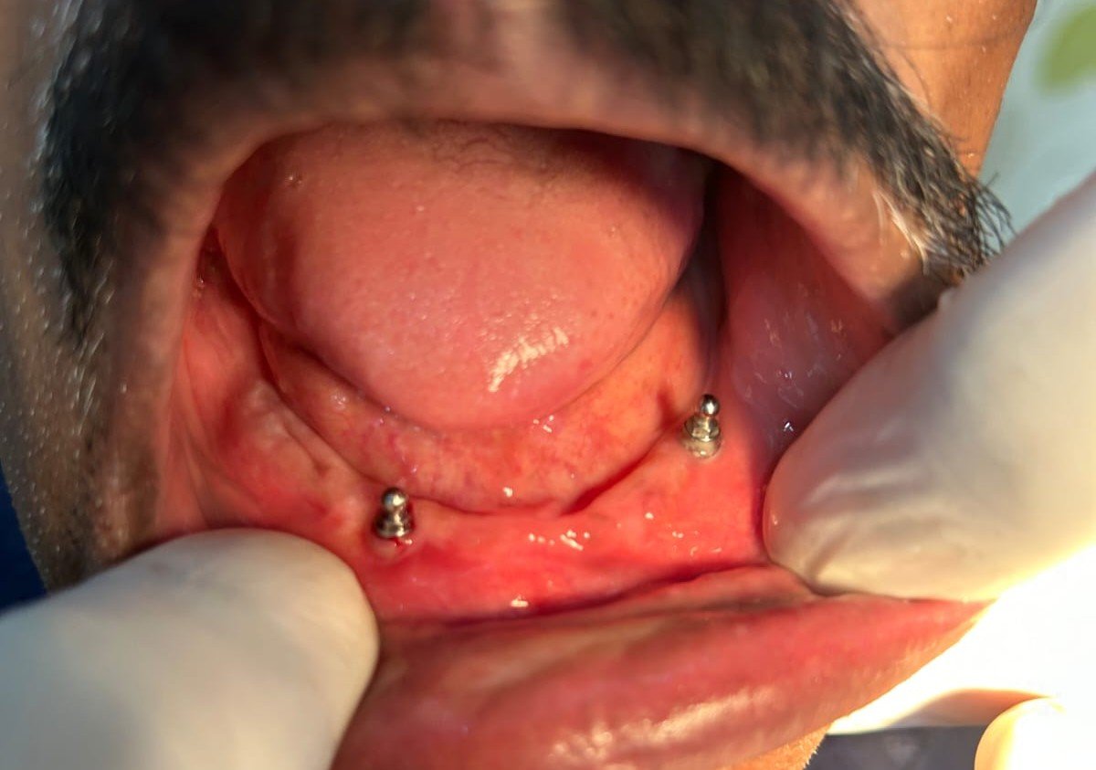 Jaw Correction Surgery