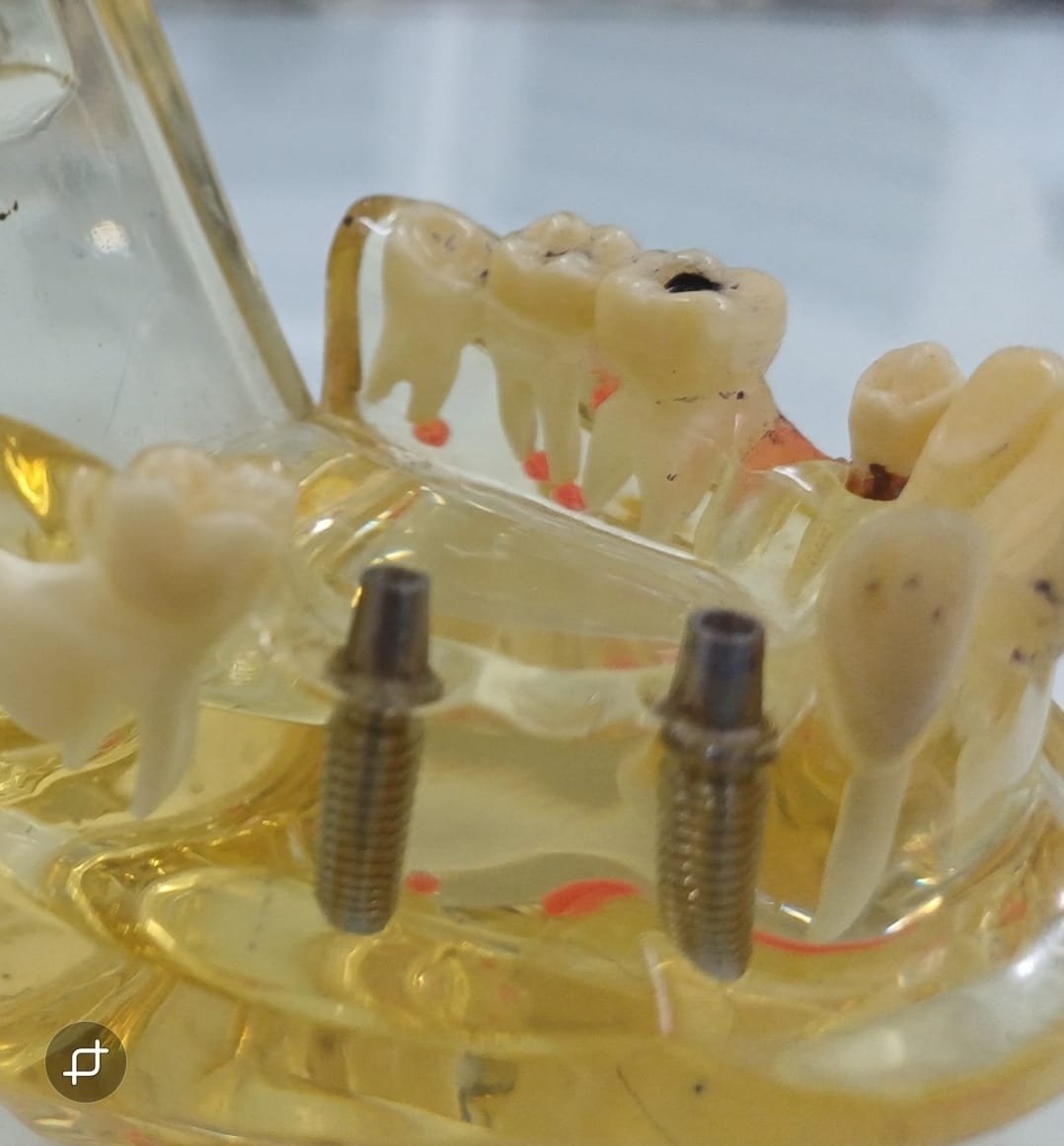 Maxillary Surgery Result