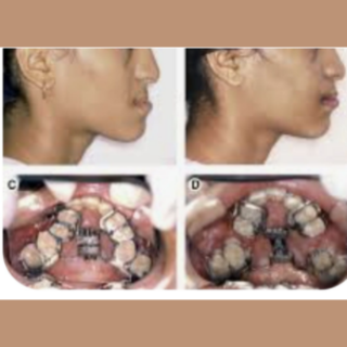Maxillary Prognathism Treatment
