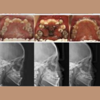 Orthognathic Surgery Procedure