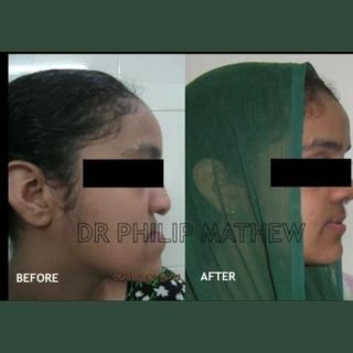 Maxillary Prognathism Treatment