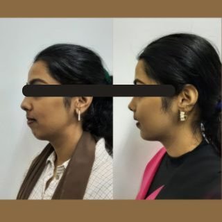 Maxillary Prognathism Treatment