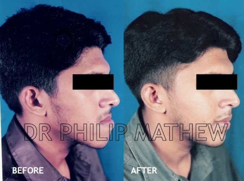 Orthognathic Surgery Procedure